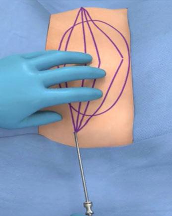 Picture of FAT Harvesting Procedure
