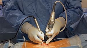 Endoscopic Spine Surgery