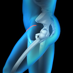 Anterior Hip Replacement Images