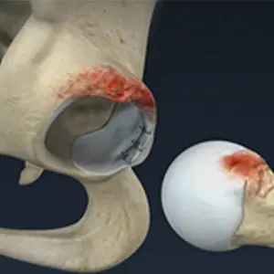 Femoroacetabular Impingement Images