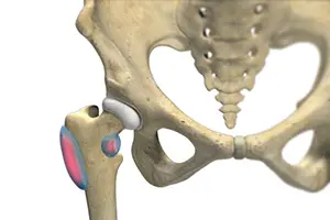 Hip Bursitis Images