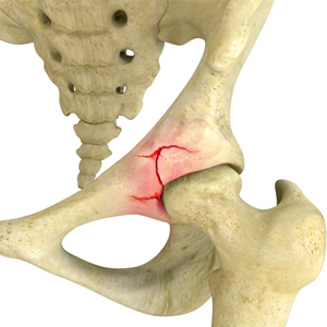 Hip Fracture Images