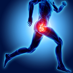 Mako Robotic-Arm Assisted Technology for Hip Replacement