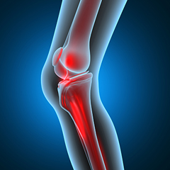 Mako Robotic-Arm Assisted Technology for Total Knee Replacement