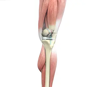 Outpatient Knee Replacement Images