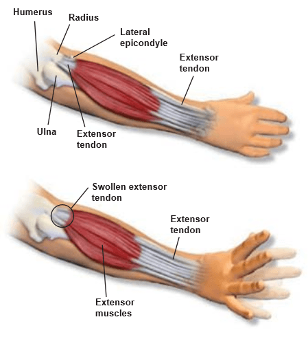 Lateral Epicondylitis San Luis Obispo Tennis Elbow Treatment Santa Lateral Epicondylitis San Luis Obispo Tennis Elbow Treatment Santa