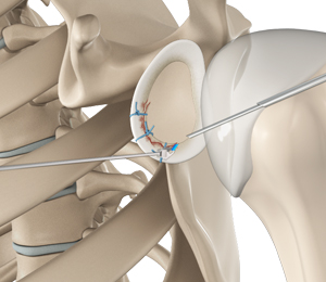 Arthroscopic Bankart Repair