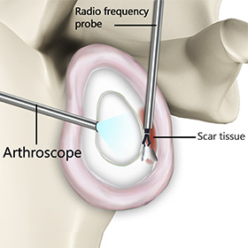 Capsular Release Image