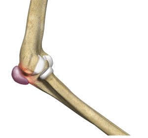 Elbow (Olecranon) Bursitis