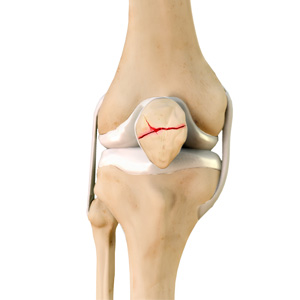 Fractures of the Patella