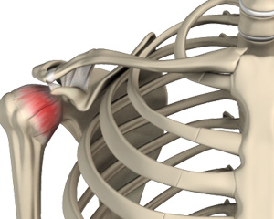 Frozen Shoulder Image