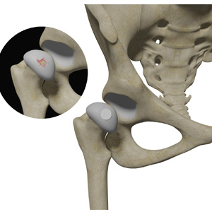Hip Cartilage Repair Image