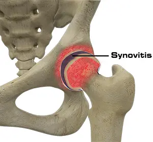 Hip Synovitis Image