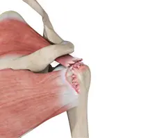 Superior Capsule Reconstruction Image