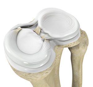Meniscal Injuries Image