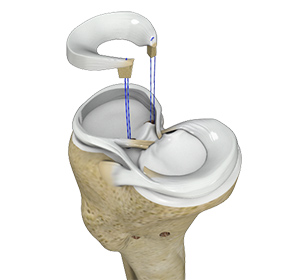 Meniscal Transplantation Image