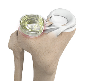 Meniscus Replacement - OrthoMiami