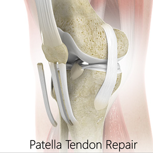 Patellar Tendon Rupture