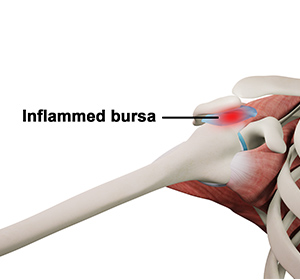 What is Rotator Cuff Bursitis