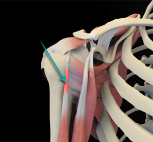 Shoulder Tendonitis Image