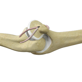 Ulnar Collateral Ligament (UCL) Injury