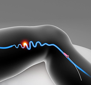 Varicose Vein Treatment Miami