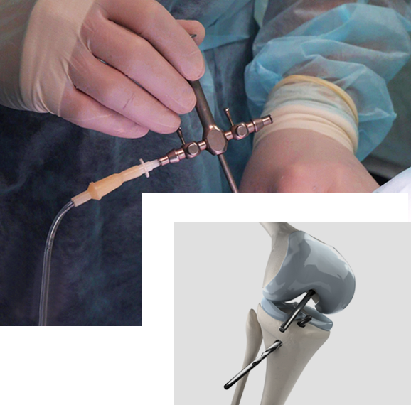 Minimally Invasive Surgery - Incisionless Surgery
