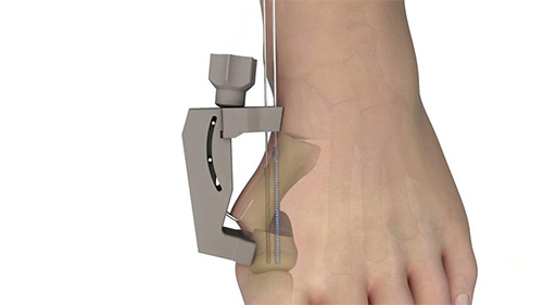  PROstep MIS MICA SOLO Procedure Guide Surgical Animation