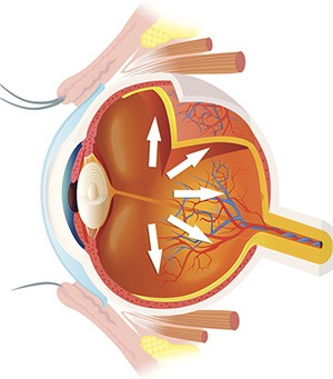 Glaucoma Pic