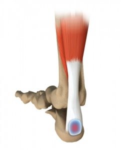 Achilles Tendon Bursitis1