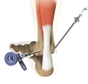 Ankle Arthroscopy pic