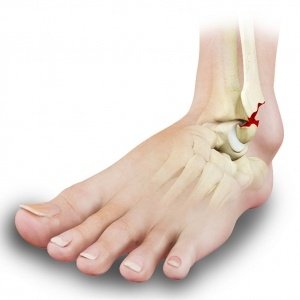 Ankle Fractures1