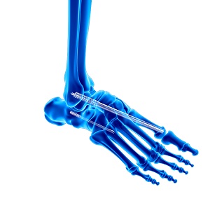 Charcot Foot Reconstruction pic