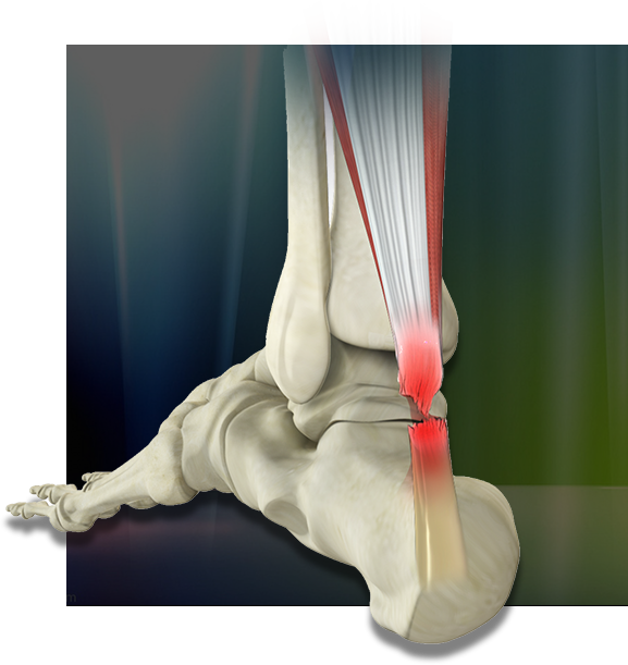 Achilles Tendon Repair Img
