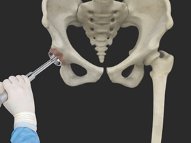 Robotic Assisted Hip Replacement img