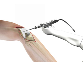 Robotic Assisted Partial Knee Surgery img