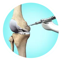 Robotic Assisted Joint Replacement Images