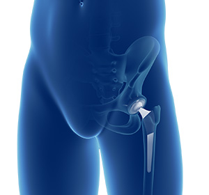 Robotic Assisted Hip Replacement images
