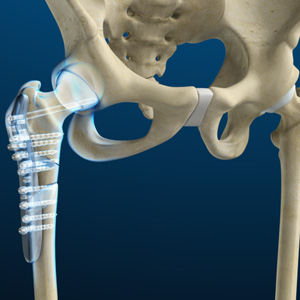 Hip Fracture Surgery Images