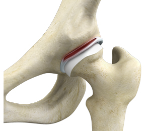 Hip Labral Tear Images