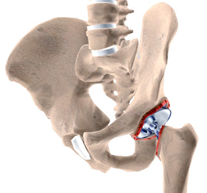 Revision Hip Replacement Images
