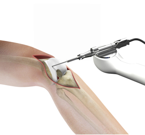 Robotic Assisted Knee Replacement Images