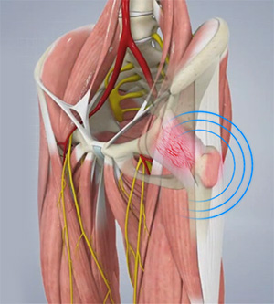 Snapping Hip Syndrome Images