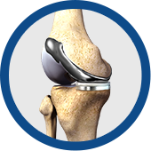 Custom Knee Implants Images