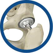 Outpatient Hip Replacement Images