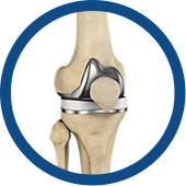 Outpatient Knee Replacement Images