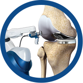Mako SmartRobotics for Partial Knee Replacement Images