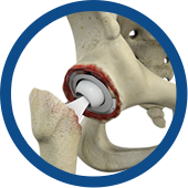 Revision Hip Replacement Images