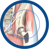 SuperPath® Hip Replacement Images