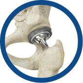 Minimally Invasive Total Hip Replacement Images